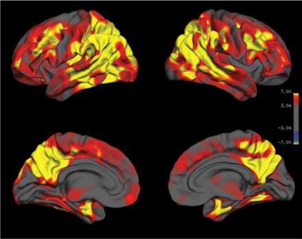 Ocena morfometryczna kory mózgowej pozwala na różnicowanie między chorobą Alzheimera i otępieniem czołowo-skroniowym