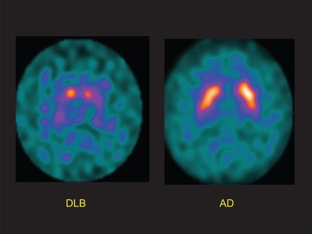 Różnicowanie między chorobą Alzheimera a otępieniem z obecnością