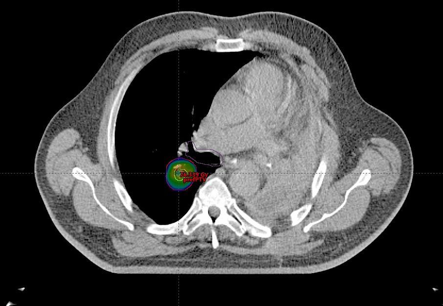 2007 lewostronna pneumonektomia, T2N0 SqNSCLC 03.