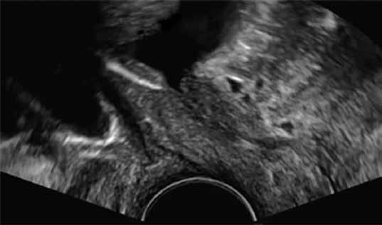 Rola badania ultrasonograficznego w diagnostyce powikłań po operacjach z powodu WNM 449 Taśma położona pod szyją pęcherza Przy nieprawidłowym położeniu taśmy pod szyją pęcherza (ryc.