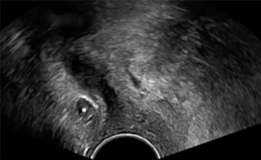 Rola badania ultrasonograficznego w diagnostyce powikłań po operacjach z powodu WNM 451 Taśma zlokalizowana asymetrycznie wokół cewki moczowej w płaszczyźnie czołowej albo osiowej Taśma położona