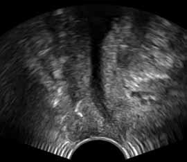 Rola badania ultrasonograficznego w diagnostyce powikłań po operacjach z powodu WNM 453 Nietrzymanie moczu początkowo tylko podczas wstawania Takie objawy mogą wystąpić jeszcze w szpitalu lub