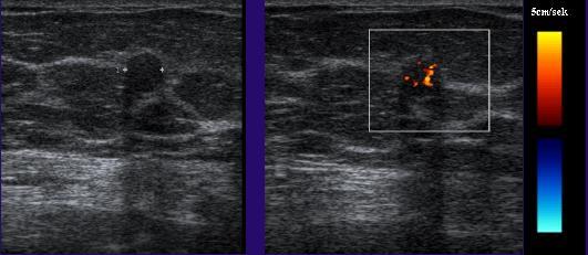 jednodniowa : MG, tomosyneza, usg z color doppler i elastrografią BIRADS 1 BIRADS 2 - następne badania