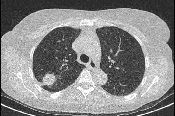 od podejrzenia do rozpoznania nowotworu rak płuca raki położone obwodowo w miąższu płuc guzek łatwy