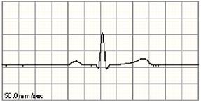 6 Monitorowanie EKG, arytmii, odcinka ST i odstępu QT elektrody EKG i kable wskazane przez firmę Philips. Niektóre nieautoryzowane elektrody mogą wykazywać duży offset potencjału z powodu polaryzacji.