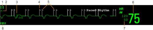 6 Monitorowanie EKG, arytmii, odcinka ST i odstępu QT Informacje dotyczące ekranu EKG Ekran określonego monitora może być skonfigurowany w inny sposób i będzie wyglądać nieco inaczej.