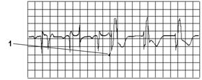 6 Monitorowanie EKG, arytmii, odcinka ST i odstępu QT Określanie trybu stymulacji (odrzucanie impulsów stymulacyjnych) Wmenu Ustawienia EKG wybierz opcję Tryb stymulacji w celu wybrania ustawienia Wł.