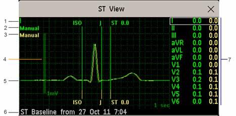 6 Monitorowanie EKG, arytmii, odcinka ST i odstępu QT Aby wyświetlić okno Widok ST, wybierz z ekranu dowolny wycinek.