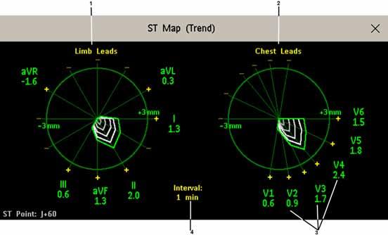 6 Monitorowanie EKG, arytmii, odcinka ST i odstępu QT Widok trendu W widoku trendów można obejrzeć maksymalnie cztery przedstawione w postaci trendów mapy ST i jednocześnie bieżącą mapę ST.