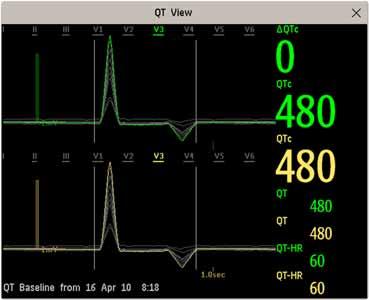 6 Monitorowanie EKG, arytmii, odcinka ST i odstępu QT Widok QT W przypadku użycia trybu wszystkich odprowadzeń należy upewnić się, że porównywane są wyniki pomiarów pochodzących z tego samego zestawu