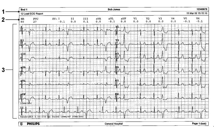 26 Drukowanie raportów pacjenta Raport czasu rzeczywistego Raporty EKG 1 Dane demograficzne pacjenta, datownik 2 Aktywne alarmy i komunikaty