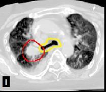 SBRT: ILD 3056 p., I-II st. NSCLC i ILD; ryzyko >3 st. toksyczności i śmiertelność: - SBRT: 25%, 15,6% (sugerowana dawka śr.