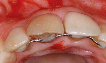 implantów stomatologicznych za pomocą Geistlich Fibro-Gide podczas