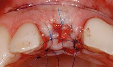 tkanek miękkich wokół implantów stomatologicznych podczas jednoczesnego 