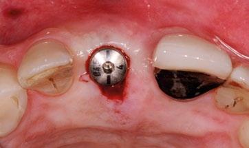 Implant prześwituje przez śluzówkę o cienkim biotypie.