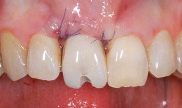 zęba. 2 Widok początkowy od strony okluzji: niedobór tkanek miękkich po