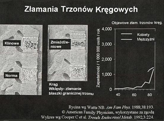 ZŁAMANIA KRĘGOSŁUPA W złamaniach trzonów kręgów w przebiegu osteoporozy wyróżnia się 3 rodzaje złamań: