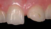 IDEALNE WŁAŚCIWOŚCI Naturalna fluorescencja Odcienie do zębiny i szkliwa zapewniają różne właściwości fluorescencyjne oparte o