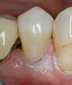SL gwarantuje dobrą penetrację włókien kolagenowych i kanalików zębinowych wraz z niezawodnym zwilżaniem powierzchni zęba. Powstawanie mikroszczelin w ścianach osiowych ubytku klasy V szczelina/μm 0.
