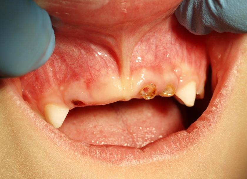 innych zębach mlecznych i zębach stałych wpływ na zdrowie ogólne,