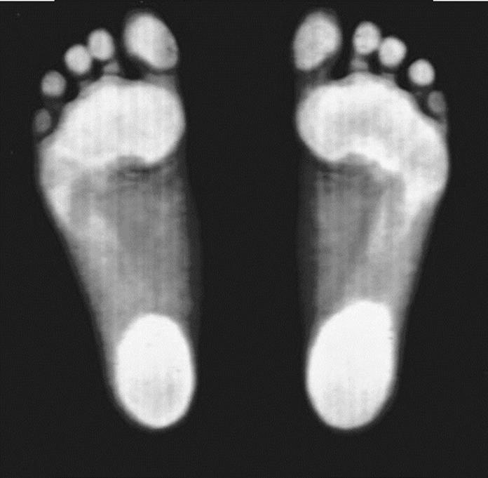 Body weight and the medial longitudinal foot