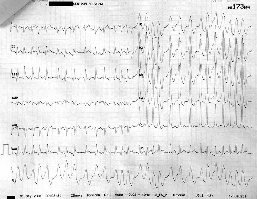 Bartosz Szafran, Facebook leczy rzecz o miłośnikach elektrokardiologii zgromadzonych w grupie Lubię EKG Rycina 2. Rycina 3. Długo nie trzeba było czekać na odpowiedź.