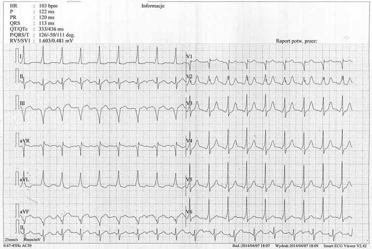 Bartosz Szafran, Facebook leczy rzecz o miłośnikach elektrokardiologii zgromadzonych w grupie Lubię EKG przed zespołami QRS (dobrze to widać w avr).