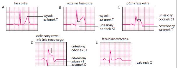 Nieprawidłowości w EKG. Ewolucja zawału mięśnia sercowego. Zmiany w EKG zależne od fazy.