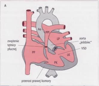 Etiologia i patogeneza Wystąpienie wady kojarzy się z różyczką przebytą przez matkę w I trymestrze ciąży. Obraz kliniczny Znaczenie przetrwałego przewodu tętniczego zależy od jego wielkości: 1.