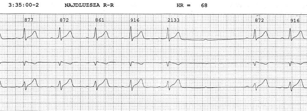 Wojciech Skawski i wsp., Zespół Brugadów długa droga do prawidłowego rozpoznania Rycina 1. Zapis elektrokardiograficzny metodą Holtera.