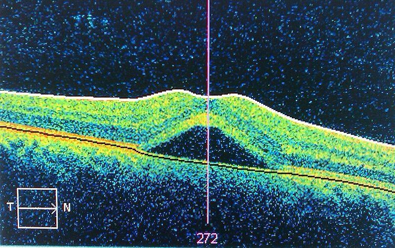 serous retinopathy, imaged