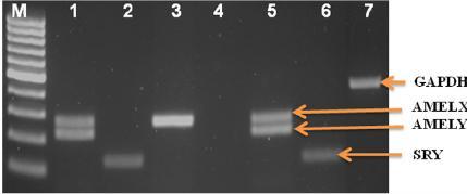 PŁEĆ GENETYCZNA białko SRY działa poprzez dwa mechanizmy: jako represor blokuje aktywność genu aromatazy p450 (białko p450 przekształca męski hormon testosteron w żeński estradiol) jako aktywator