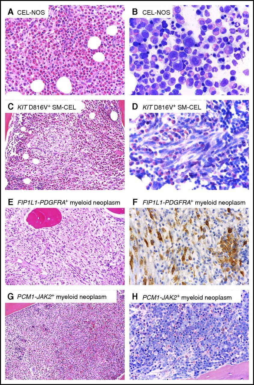 Representative BM histomorphology of different myeloid neoplasms with eosinophilia.