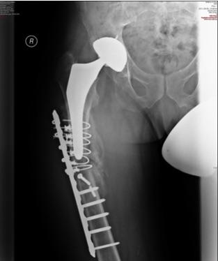 Po 3 miesiącach usunięto stabilizator zewnętrzny. Ryc. 8. Wykonano reimplantację trzpienia endoprotezy sp. Profemur R.