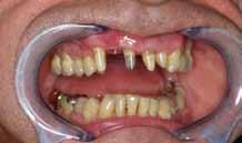 Ząb 11 zaopatrzono wkładem korzeniowym.