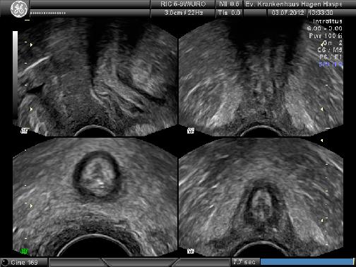 Pelvic Floor Sonografia