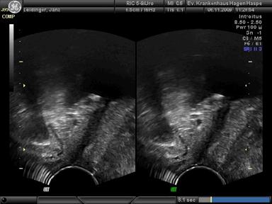 Pelvic Floor Sonografia