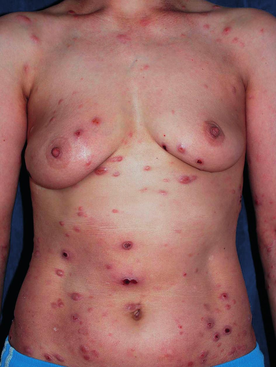 Numerous erythematous-infiltrative lesions and nodules with a tendency to ulceration on the skin of the back on the first day of hospitalization Figure 2.
