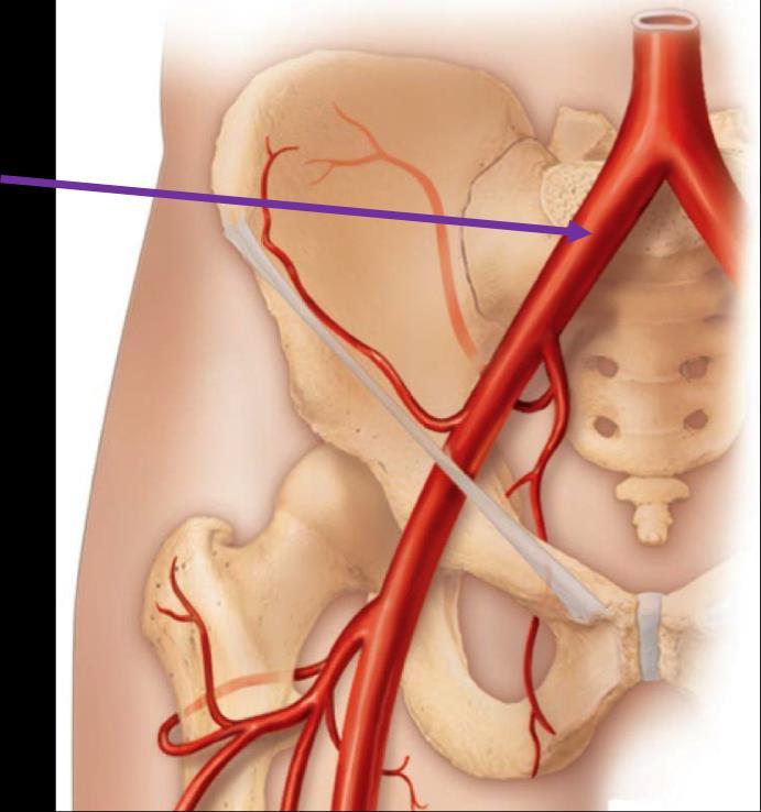 TĘTNICA BIODROWA WSPÓLNA Tętnica biodrowa wspólna unaczynia narządy miednicy, a oprócz tego jest głównym naczyniem zaopatrującym kończynę dolną.