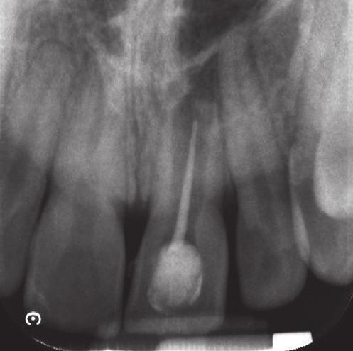 2/2017 fot. archiwum autorów 1 Ryc. 1. RTG z widocznym ćwiekiem gutaperkowym kontrolnym założonym na długość 17 mm badanie stomatologiczne, pacjent nie odczuwał żadnych dolegliwości.