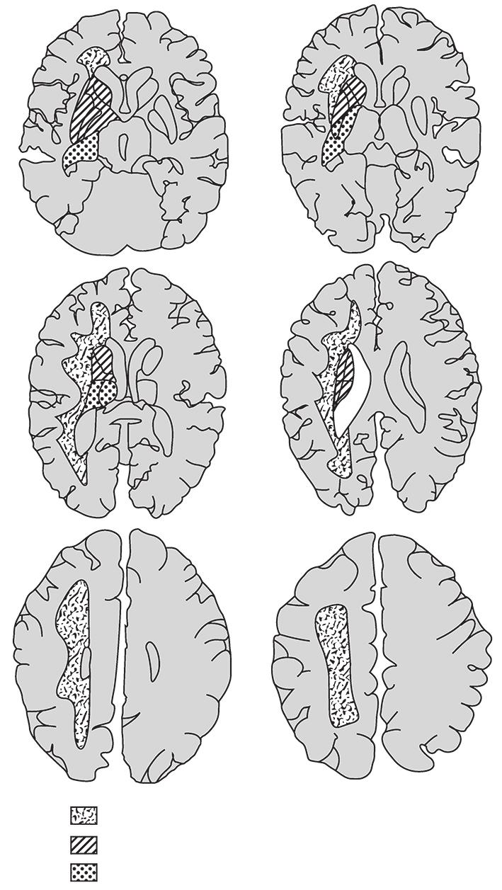 118 rozdział 3 (a) (b) (c) (d) (e) (f) Obszar unaczynienia istoty białej przez gałe zie rdzenne (przeszywające) Obszar unaczynienia przez te tnice