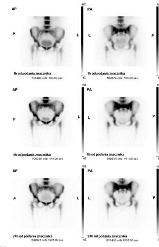 Kryteria oceny scyntygrafii ze znakowanymi WBC wizualne porównanie obrazów po 1h, 4h oraz po 20-24h