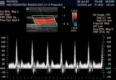 Przykłady obrazowań 2D + CFM + widmo sygnału dopplerowskiego 2D M Obrazowanie typu A - N nadajnik - W wzmacniacz odbiornika - GI generator impulsów (sygnałów nadawanych i sterujących) - PS blok