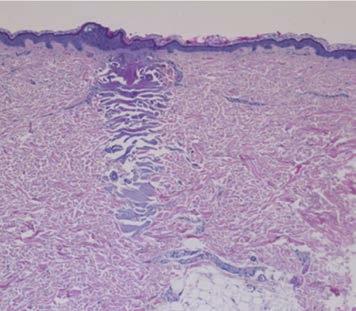 Badanie histologiczne pokazujące działanie izolowanych mikroigieł Fractora nieablacyjna penetracja igieł w skórze, brak powierzchownego uszkodzenia termicznego, frakcyjne uszkodzenie w skórze