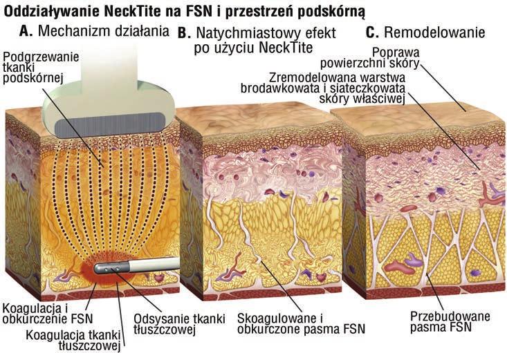 Ryc. 9. Efekt po zastosowaniu FaceTite reorientacja pasm FSN, pogrubienie warstwy siateczkowatej skóry, neokolageneza.