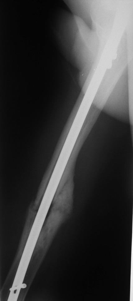 Złamanie trzonu i szyjki zespolone gwoździem rekonstrukcyjnym, rzepki popręgiem Webera, kłykcia kości piszczelowej śruba do istoty gąbczastej i kości piszczelowej stabilizatorem zewnętrznym.
