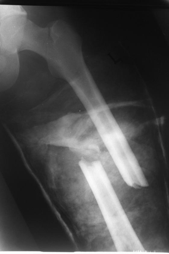 , male, 31, sustained fractures of both femoral shafts and a non-displaced left femoral neck fracture after a fall from a height of some 15 meters. The A Ryc. 2a.