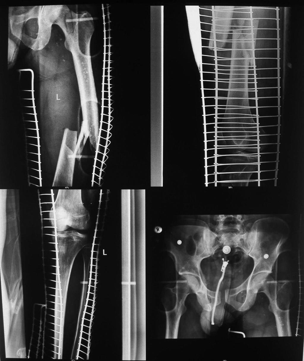 Wójcik K., Concomitant Ipsilateral Femoral Neck and Shaft Fractures. Ryc. 6. Ocena czterech małych radiogramów umieszczonych na jednej kliszy rentgenowskiej może być trudna i ryzykowne.