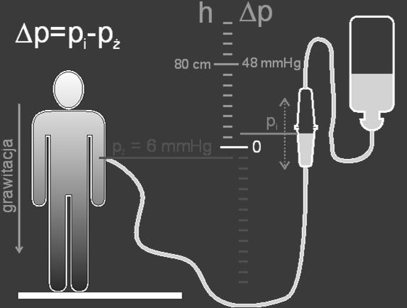 Istotna jest relacja pomiędzy ciśnieniem w żyle w miejscu wkłucia (np. żyła łokciowa), a ciśnieniem hydrostatycznym płynu infuzyjnego.