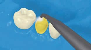 5 Wstępne opracowanie powierzchni zęba i aplikacja materiału łączącego Opcjonalny: Zastosować kwas ortofosforowy w postaci żelu (np. Total Etch) na szkliwo i pozostawić na czas reakcji 15-30 sek.
